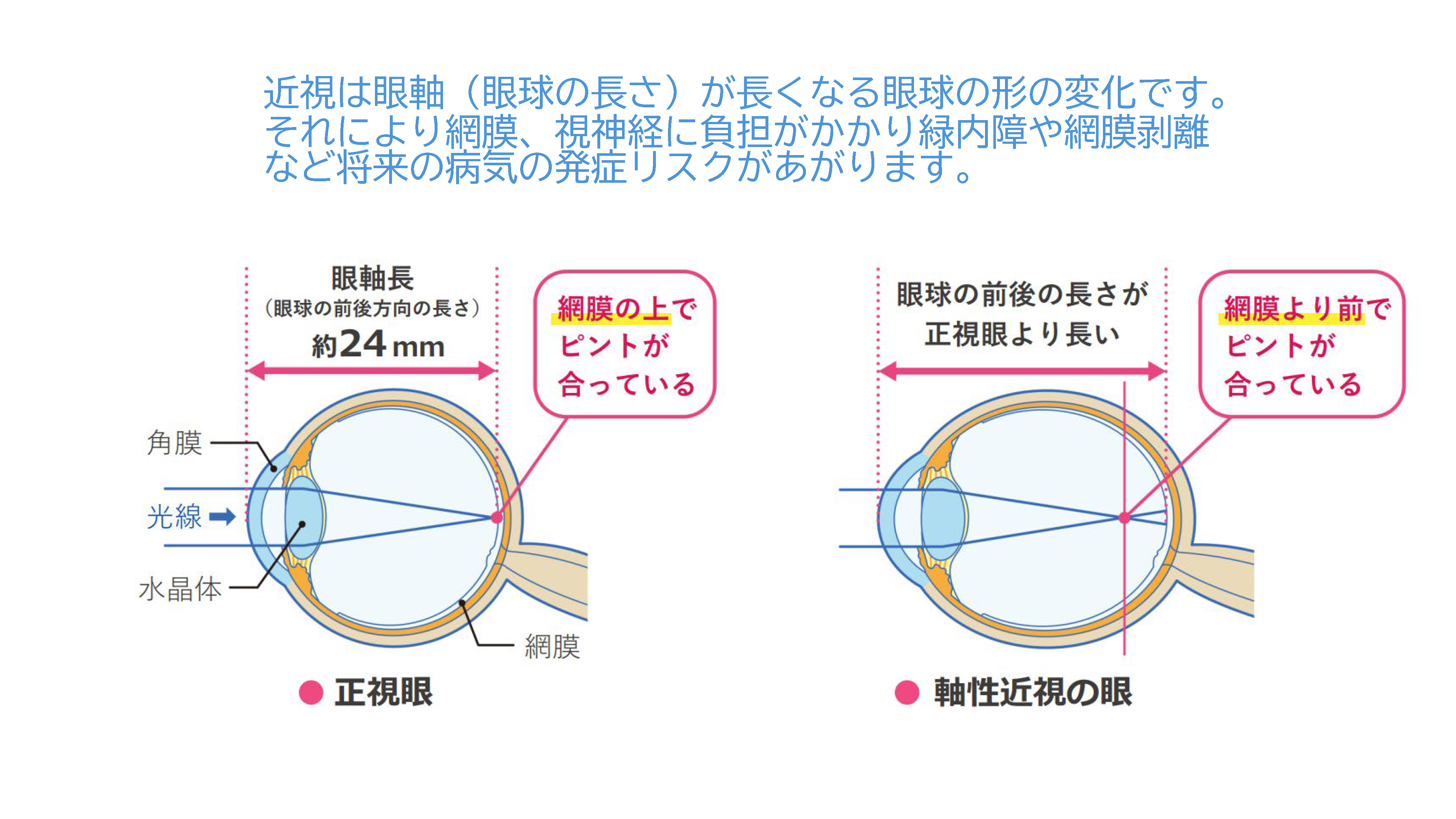 近視抑制点眼薬「リジュセアミニ」