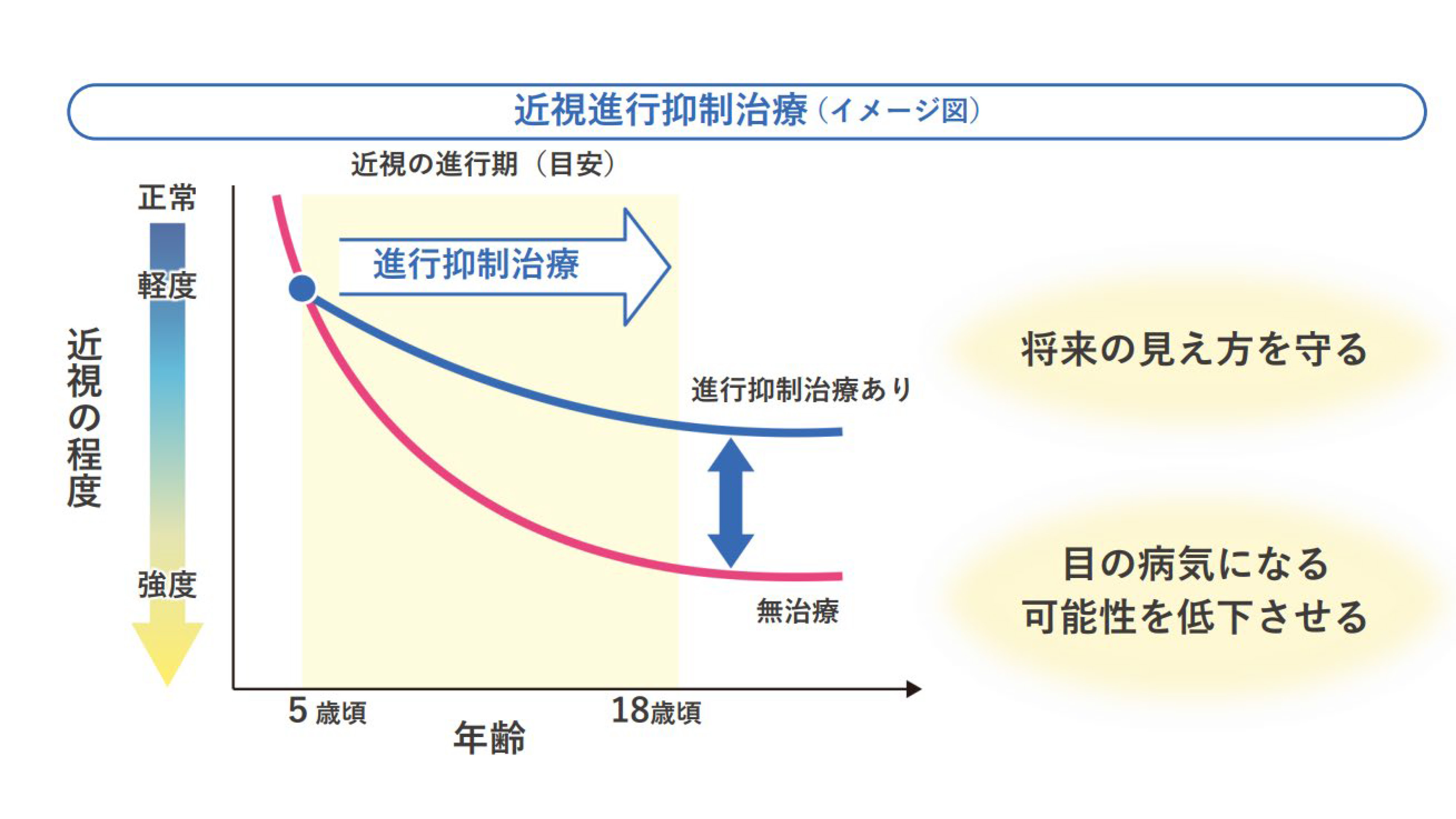 近視抑制点眼薬「リジュセアミニ」